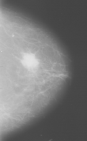 mammography.bmp (27574 bytes)